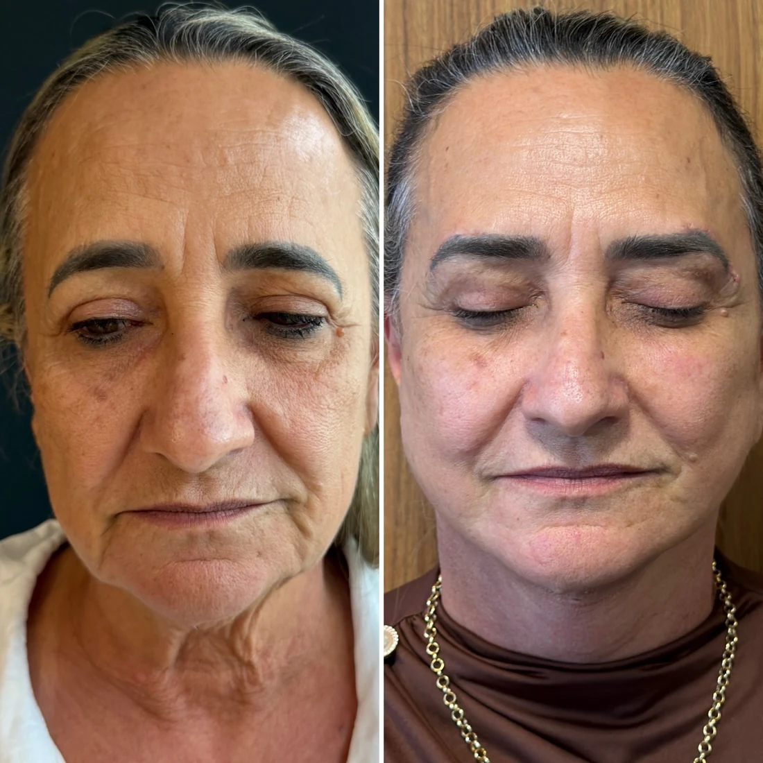 Comparação de antes e depois apresentada pela clínica, caso 01