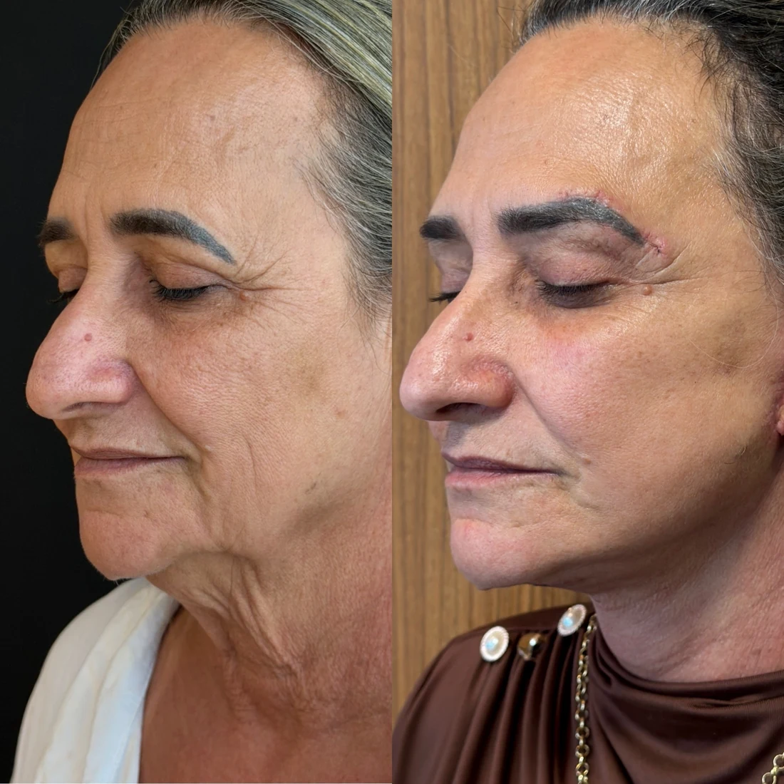 Comparação de antes e depois apresentada pela clínica, caso 02