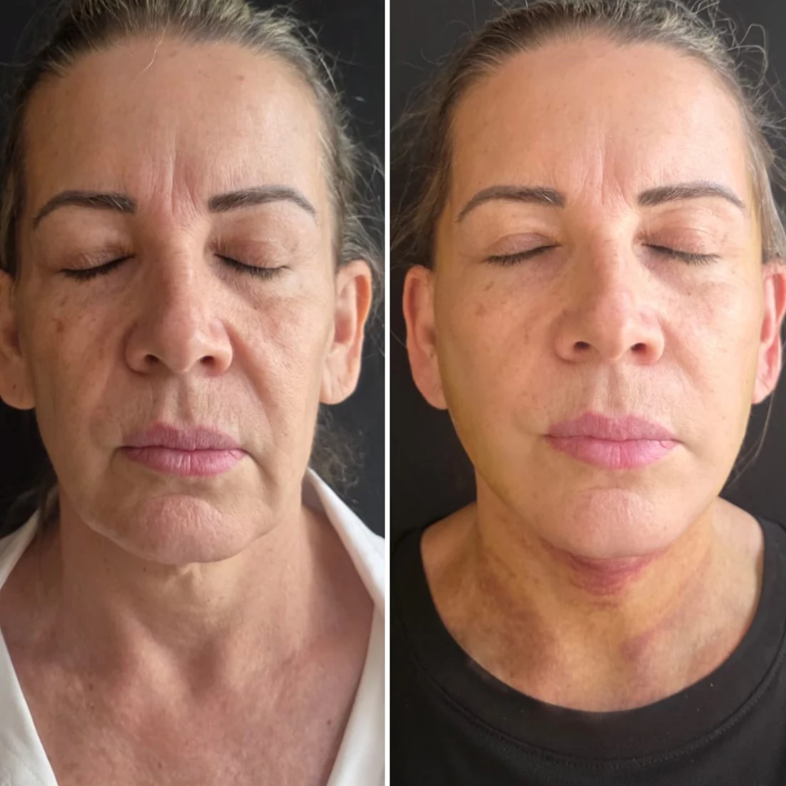 Comparação de antes e depois apresentada pela clínica, caso 03