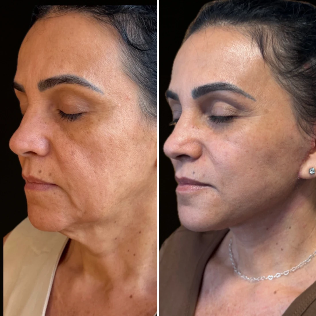 Comparação de antes e depois apresentada pela clínica, caso 05