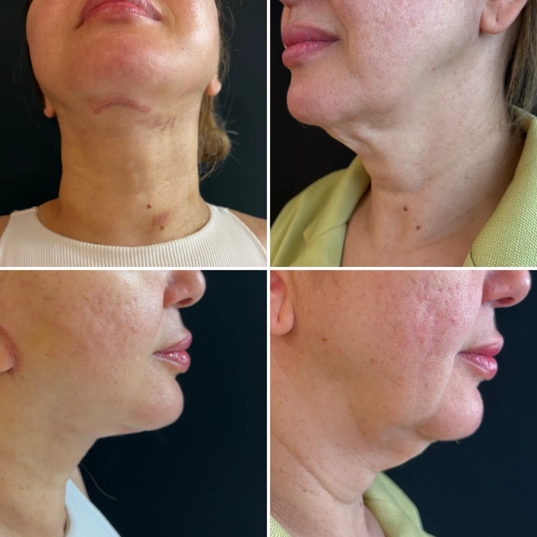 Comparação de antes e depois apresentada pela clínica, caso 06
