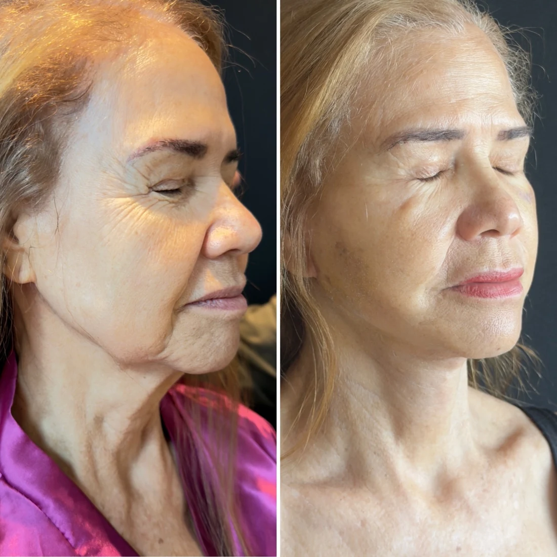 Comparação de antes e depois apresentada pela clínica, caso 07