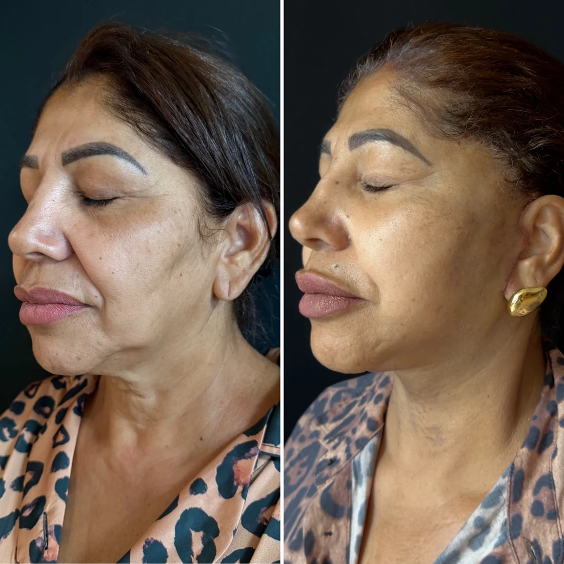 Comparação de antes e depois apresentada pela clínica, caso 12