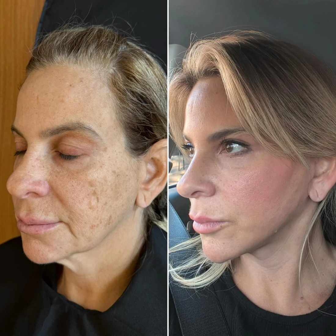 Comparação de antes e depois apresentada pela clínica, caso 13