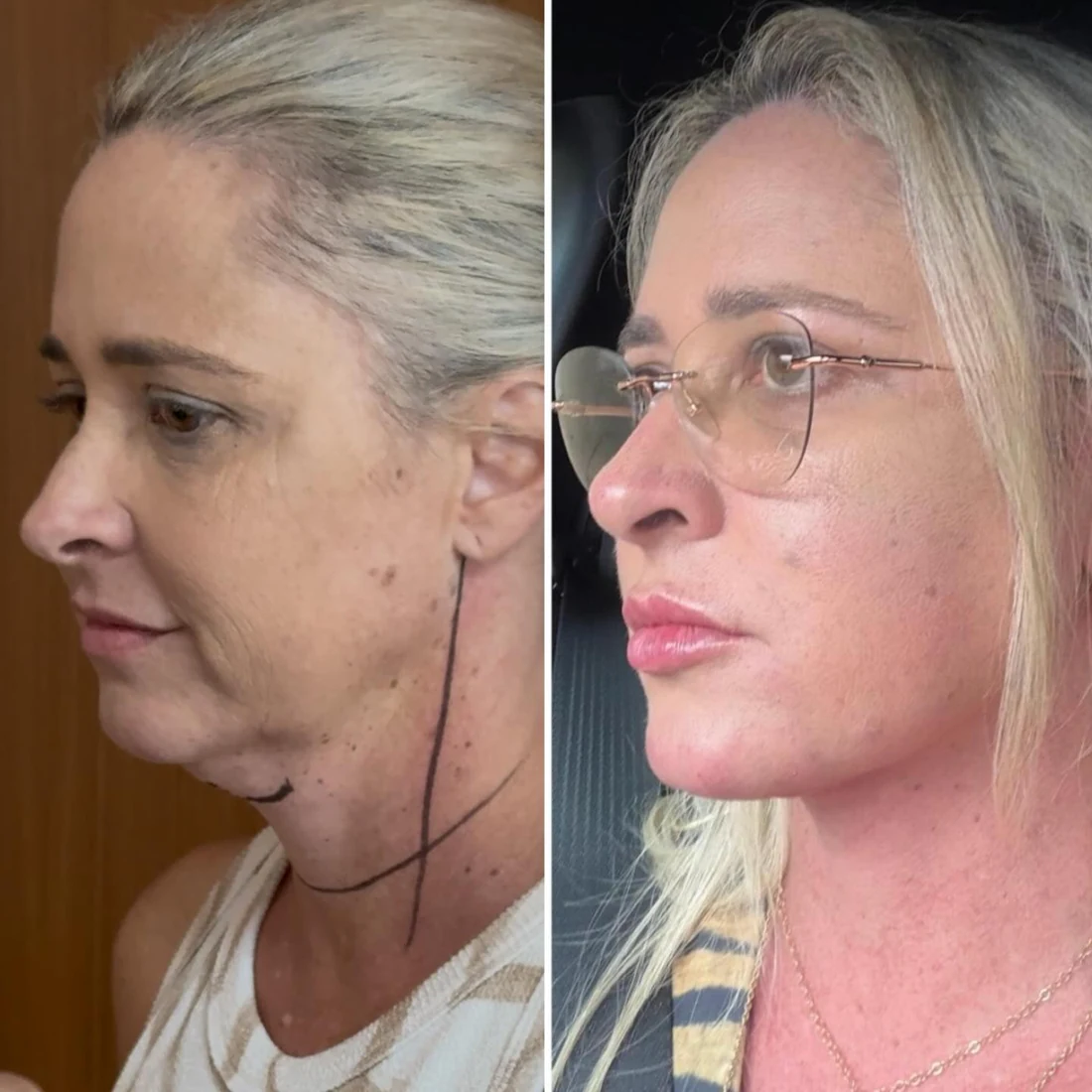 Comparação de antes e depois apresentada pela clínica, caso 14