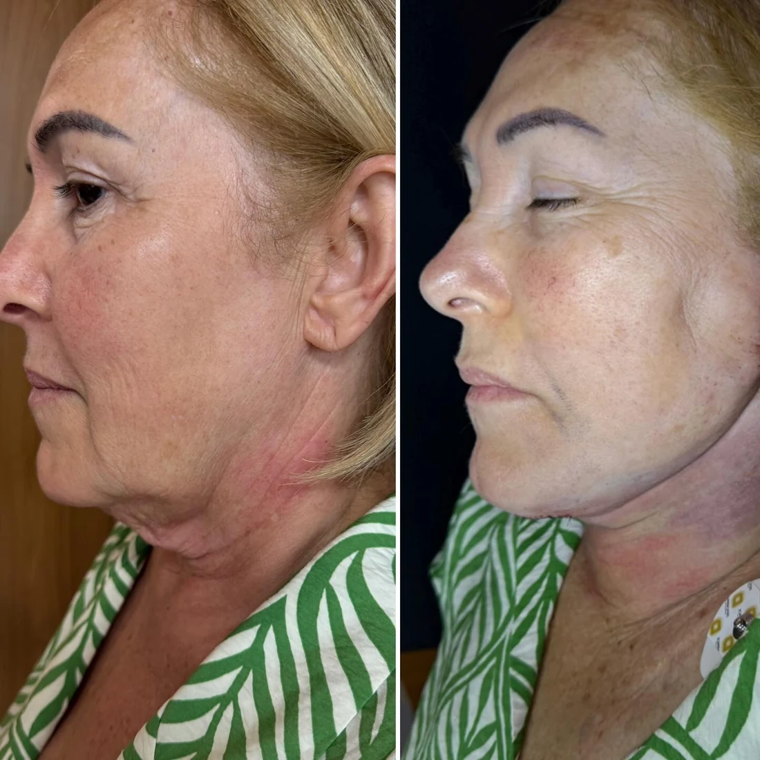 Comparação de antes e depois apresentada pela clínica, caso 15
