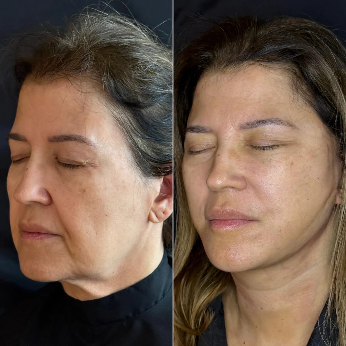 Comparação de antes e depois apresentada pela clínica, caso 16