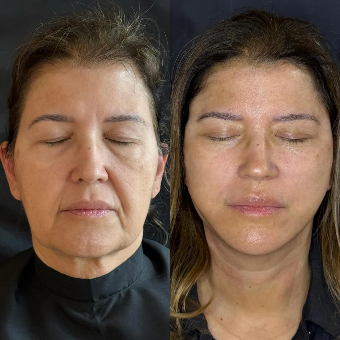 Comparação de antes e depois apresentada pela clínica, caso 17