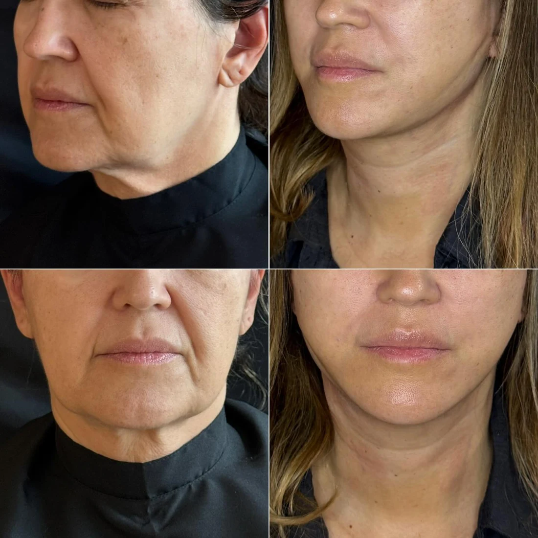 Comparação de antes e depois apresentada pela clínica, caso 18